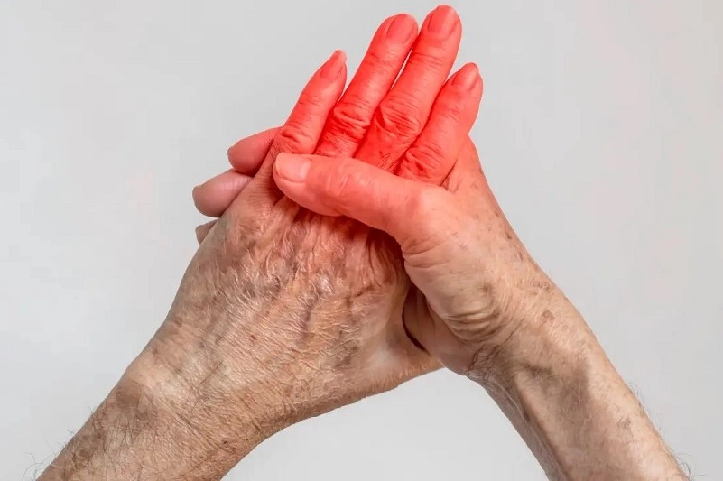 rheumatism treatment