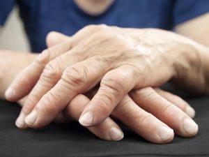علائم روماتیسم مفصلی