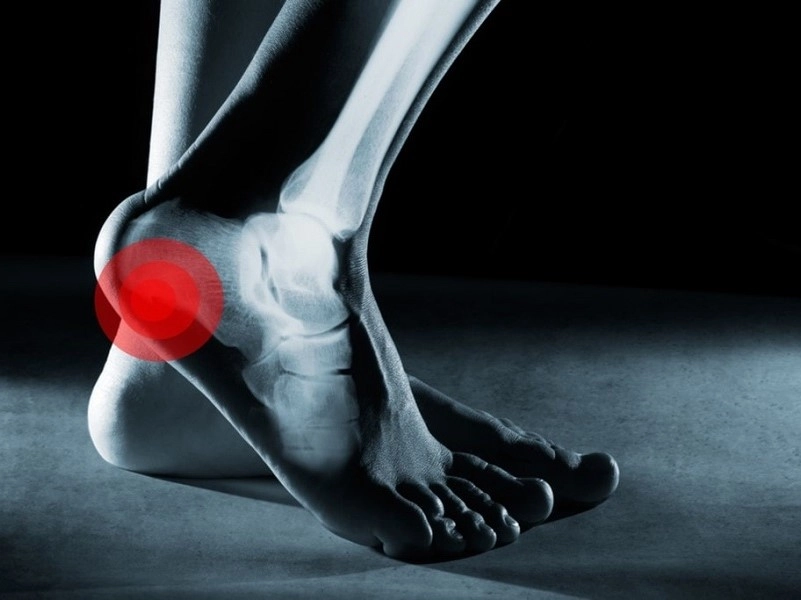 راههای تشخیص کشیدگی تاندون کف پا