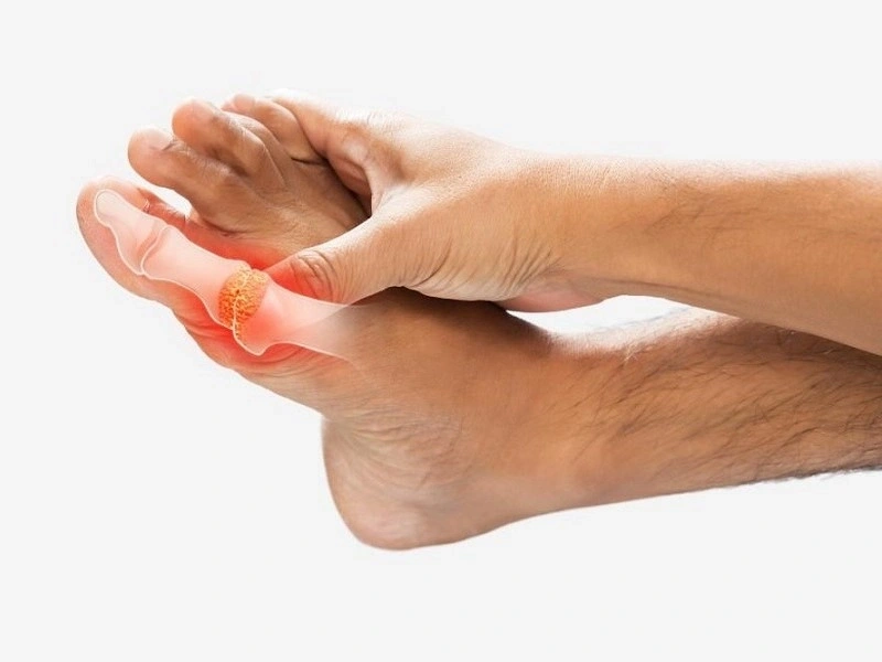 انواع آرتروز پا