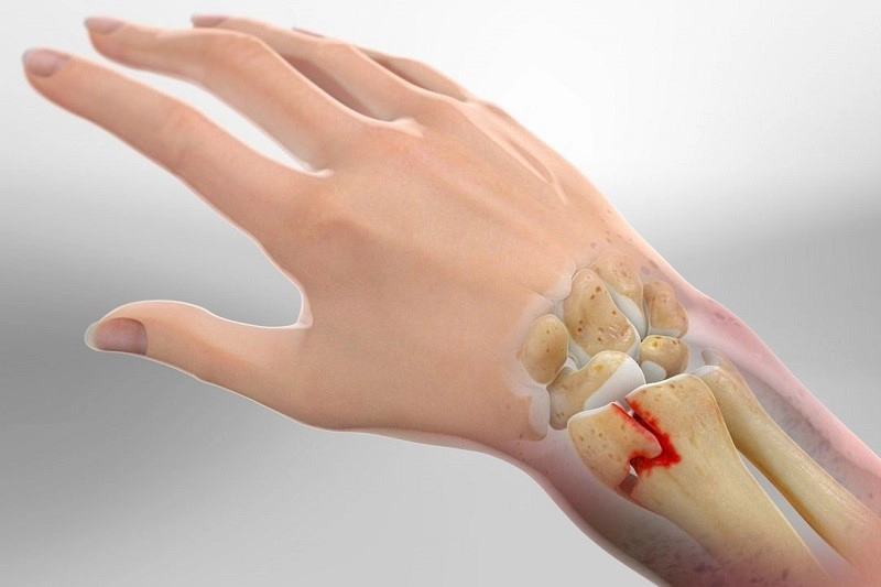 Types of wrist fractures